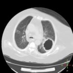 pulmonary-abscess-4